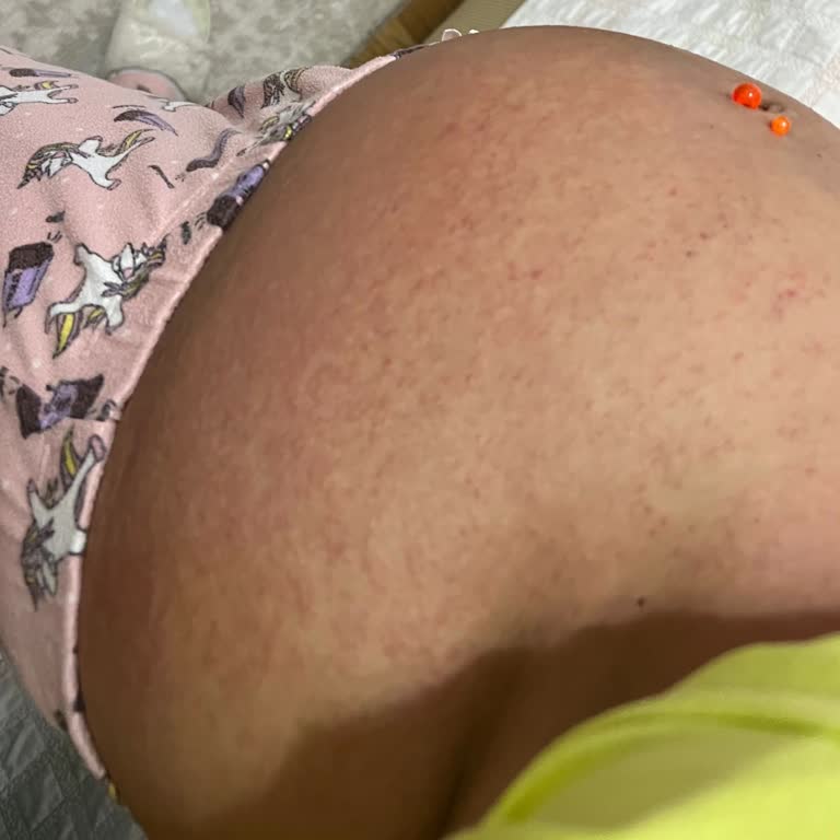 Mustela Крем от Растяжек Вызвал Аллергию во Время Беременности