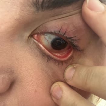 Kirpik Uygulaması Sonucu Yaşanan Sağlık Problemleri