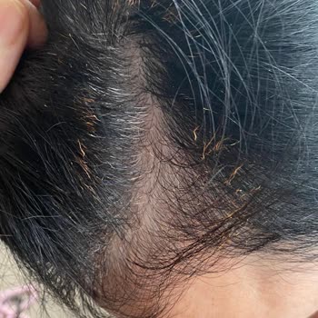 Severek Kullandığım Fanset Saç Şekillendirici Saçımı Yaktı