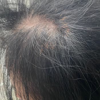 Severek Kullandığım Fanset Saç Şekillendirici Saçımı Yaktı