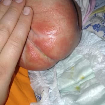 Yenidoğan Bebek Bezi Cilt Tahrişi Sorunu