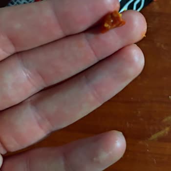 Patos Cipsin İçinden Çıkan Yabancı Madde Şoku