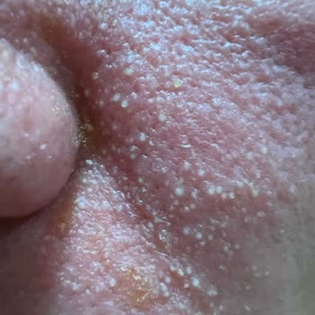 Ciltte Şiddetli Reaksiyon: Sos Serum Faciası