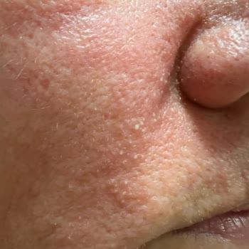 Ciltte Şiddetli Reaksiyon: Sos Serum Faciası