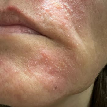 Ciltte Şiddetli Reaksiyon: Sos Serum Faciası