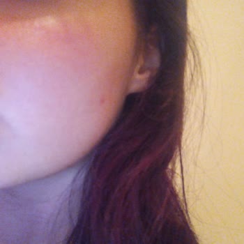 Использование косметики Nivea вызвало жжение и покраснение кожи