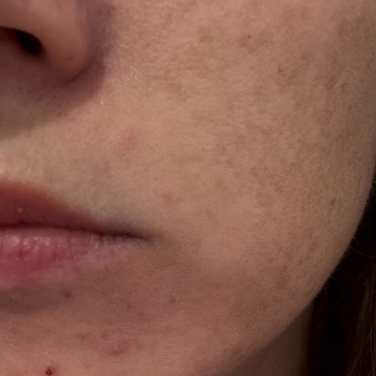 Missha Collagen вызвал высыпания на коже