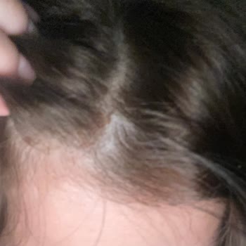 Ekip İstanbul Hair Concept Kullandıkları Açıcı Ve Boya Kafamda Alerji Ve Yanık Yaptı!