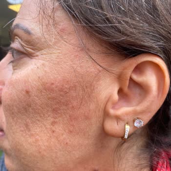 Nivea Yüz Bakım Kremi Alerjik Reaksiyona Sebep Oldu!