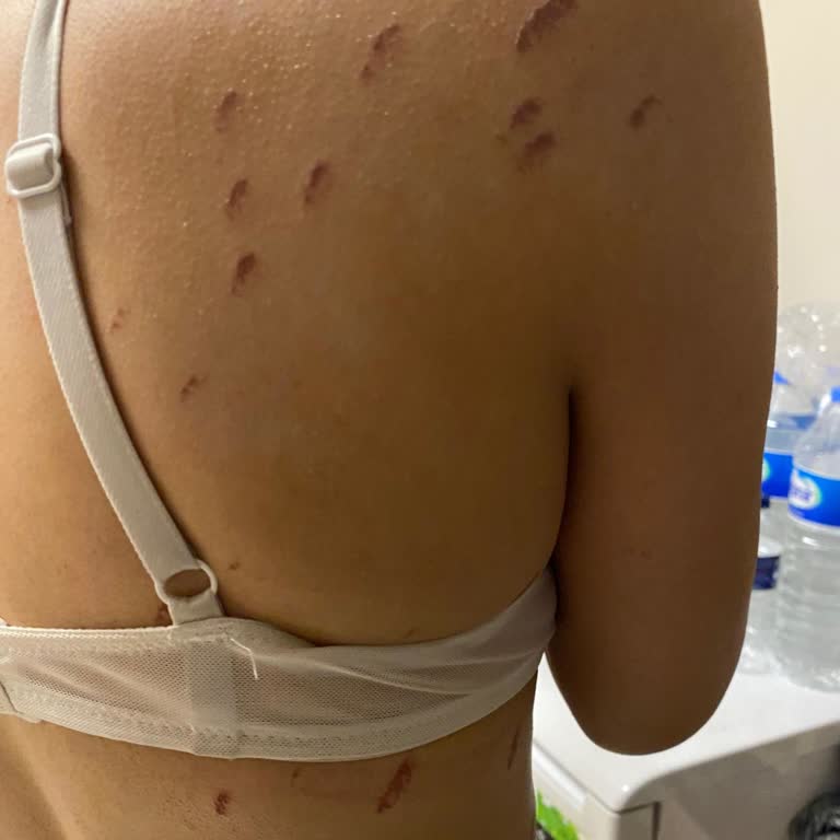 Estetikon Güzellik Merkezi (Gebze) Lazer Epilasyon Sonrası Yanık Ve İlgisizlik!