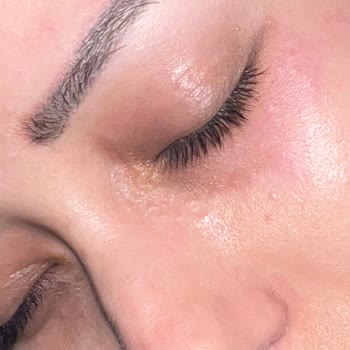 Bioderma Sensibo Eye Allergische Reaktion und Hautirritationen nach Anwendung