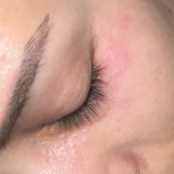 Bioderma Sensibo Eye Allergische Reaktion und Hautirritationen nach Anwendung