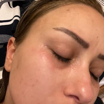 Bioderma Sensibo Eye Allergische Reaktion und Hautirritationen nach Anwendung