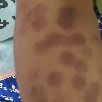 Lazer Epilasyon Sonrası Yanık Ve Yetersiz İlgi