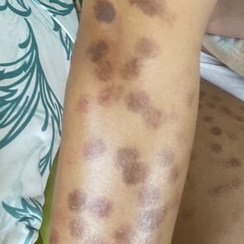 Lazer Epilasyon Sonrası Yanık Ve Yetersiz İlgi