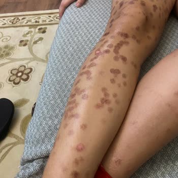 Lazer Epilasyon Sonrası Yanık Ve Yetersiz İlgi