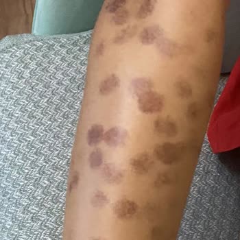 Lazer Epilasyon Sonrası Yanık Ve Yetersiz İlgi