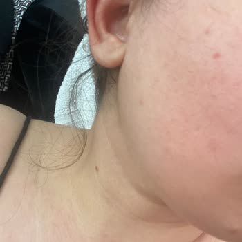 Bee Beauty Maskesi Sonrası Sivilce Şoku