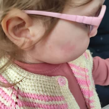 Organik Bebek Losyonu Ciltte Alerjik Reaksiyona Sebep Oldu