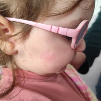 Organik Bebek Losyonu Ciltte Alerjik Reaksiyona Sebep Oldu