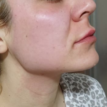 Yüz Maskesi Cildimi Yaktı, Geri Dönüş Bekliyorum