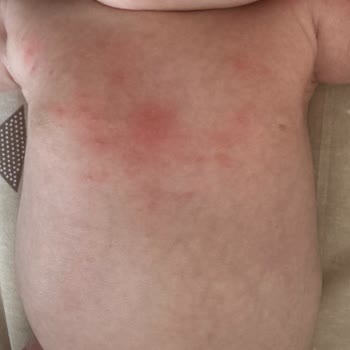 Sleepy Bebeğimde Ciddi Alerjik Reaksiyonlara Sebep Olan Ürün Hakkında Acil İnceleme Talebi