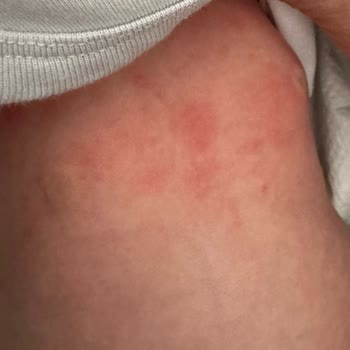 Sleepy Bebeğimde Ciddi Alerjik Reaksiyonlara Sebep Olan Ürün Hakkında Acil İnceleme Talebi