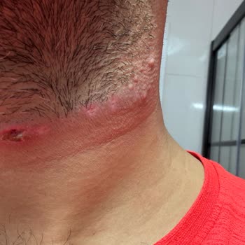 Buz Lazer İşlemi Sonrası Ciddi Tahriş Ve İlgisizlik