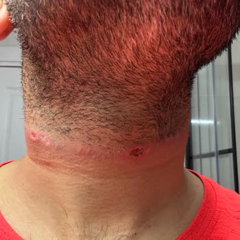 Buz Lazer İşlemi Sonrası Ciddi Tahriş Ve İlgisizlik