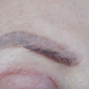 Zenlife Ant Zen Güzellik Merkezi Kaş Silme İşleminde Verilen Zarar