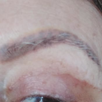 Zenlife Ant Zen Güzellik Merkezi Kaş Silme İşleminde Verilen Zarar