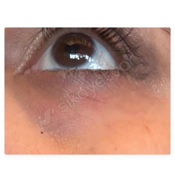 Estee Lauder Ürünleri Cilt Sorunlarına Yol Açtı