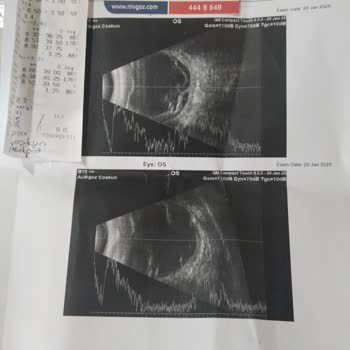Yanlış Tedavi Yüzünden Görme Kaybı