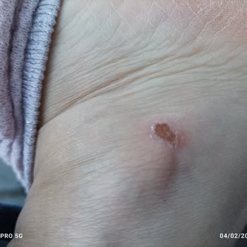 Columbia Botunda Sağ Ayakta Rahatsızlık Yaratan Çıkıntı