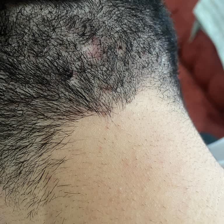 Yves Rocher Anti-Dandruff Shampoo Caused Severe Scalp Issues & Refund Denied