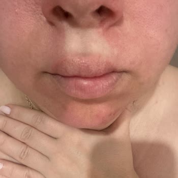 Neutrogena Peeling Sonrası Yüzde Yanma Ve Kızarıklık