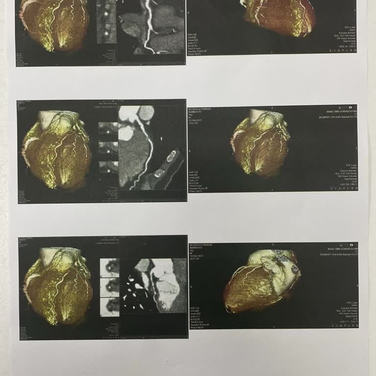 Sigorta Kapsamında Anjiyo Sorunu