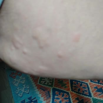 Alerji Yapan Ürün Ve İletişim Sorunu