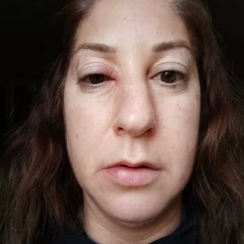 Alerji Yapan Ürün Ve İletişim Sorunu