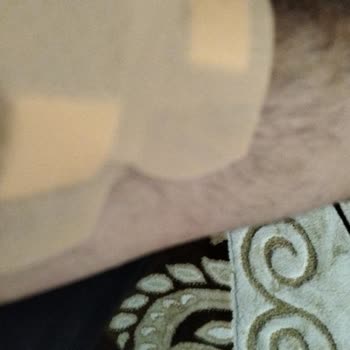 Diyaliz İğnesi Ve Kol Bandı Sorunları