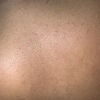Isana Alerji Yapan Ürünle Hayal Kırıklığı
