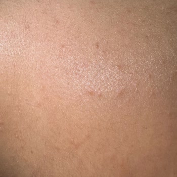 Isana Alerji Yapan Ürünle Hayal Kırıklığı