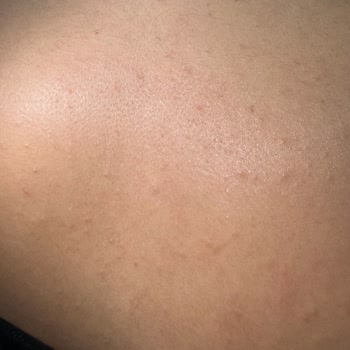 Isana Alerji Yapan Ürünle Hayal Kırıklığı