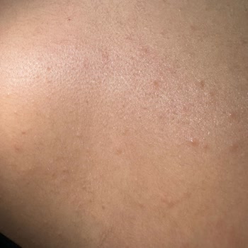 Isana Alerji Yapan Ürünle Hayal Kırıklığı