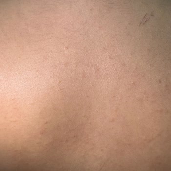 Isana Alerji Yapan Ürünle Hayal Kırıklığı