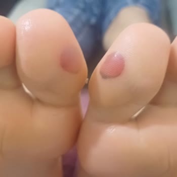 Adidas Ayakkabı Kullanımında Ağrı Ve Kan Toplanması