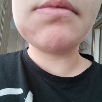 Yanlış Teşhis Ve Tedavi Sonrası Artan Diş Ağrısı