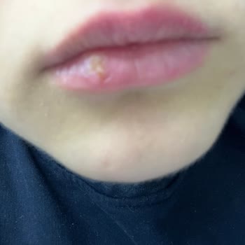 Maybelline Ürünü Dudağımda Enfeksiyona Sebep Oldu