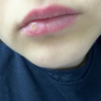 Maybelline Ürünü Dudağımda Enfeksiyona Sebep Oldu