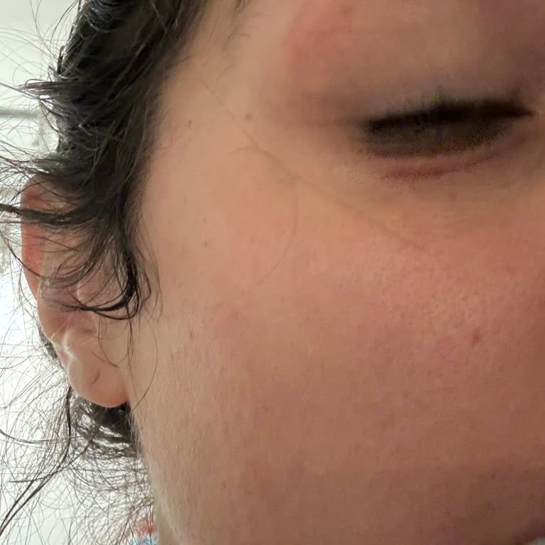 Estée Lauder Night Repair Reizungen und Ekzem unter den Augen